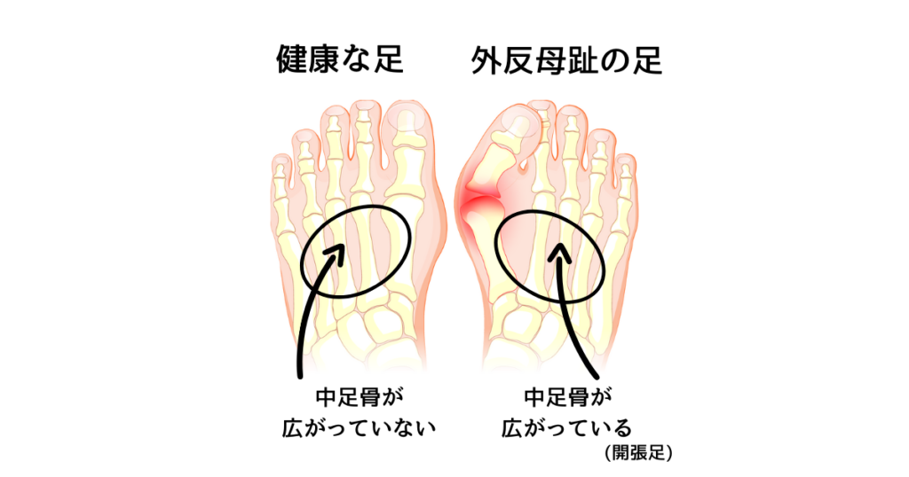 外反母趾の痛みから解放される靴選びのポイント Shoes Hachiro